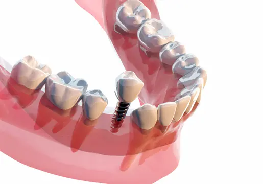 累計10,000本(2008~2024年)のインプラント埋入実績