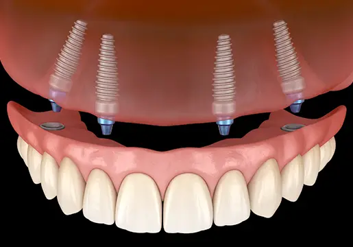 1日で叶える新しい笑顔オールオン4・6治療